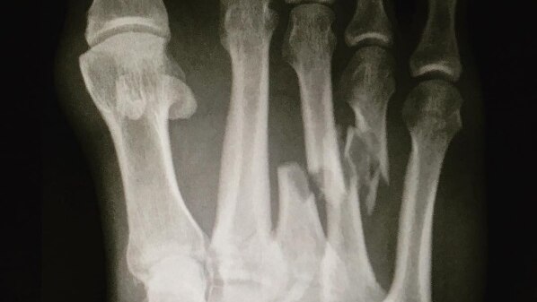 An X-ray of Kelly Slater's broken foot