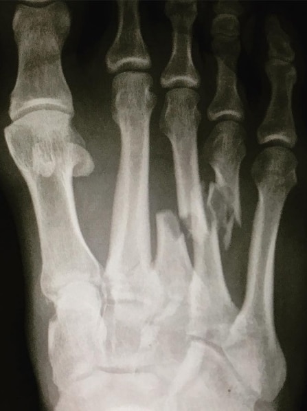 An X-ray of Kelly Slater's broken foot