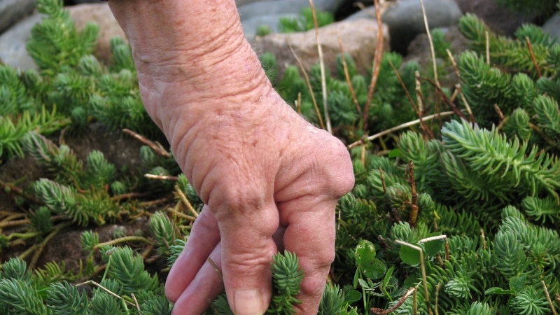 Woman gardening, her hand and fingers are misshapen with rheumatoid arthritis nodules.