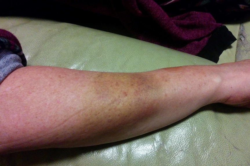 A bruise on a woman's arm.