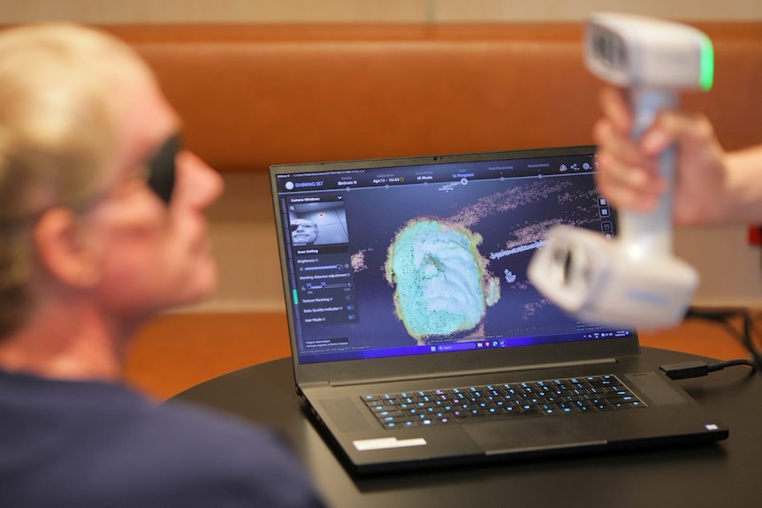 A doctor conducts a 3D facial scan of patient Craig Faull, who wears an eye patch