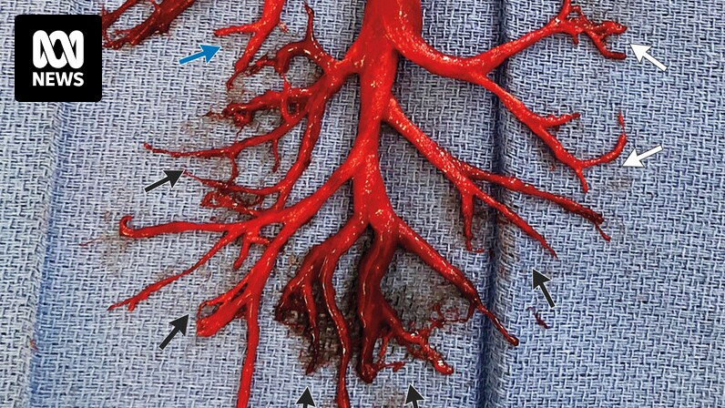 Man coughs up 15cm-wide blood clot in shape of right bronchial tree - ABC  News