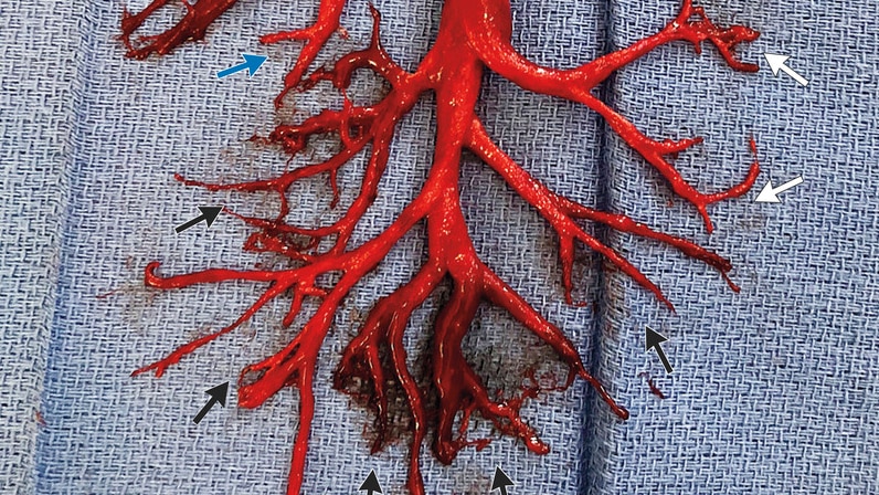 A blood clot, in the shape of the right bronchial tree, coughed up by a 36-year-old man.