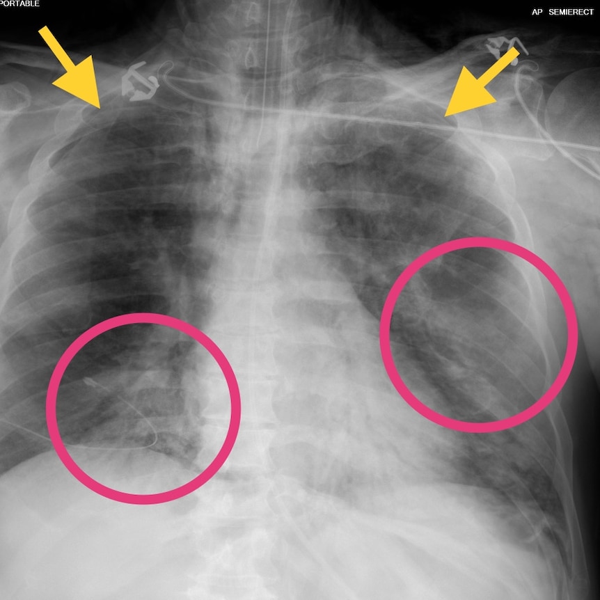 A chest x-ray shows a woman with punctured lungs who was being ventilated for COVID-19 pneumonia.