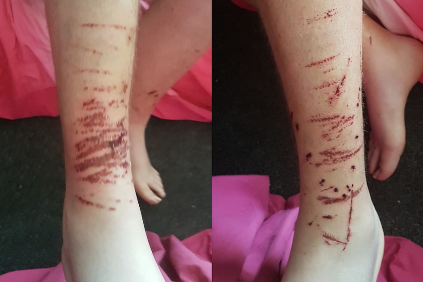 Two side-by-side images of a man's legs, covered in scratches