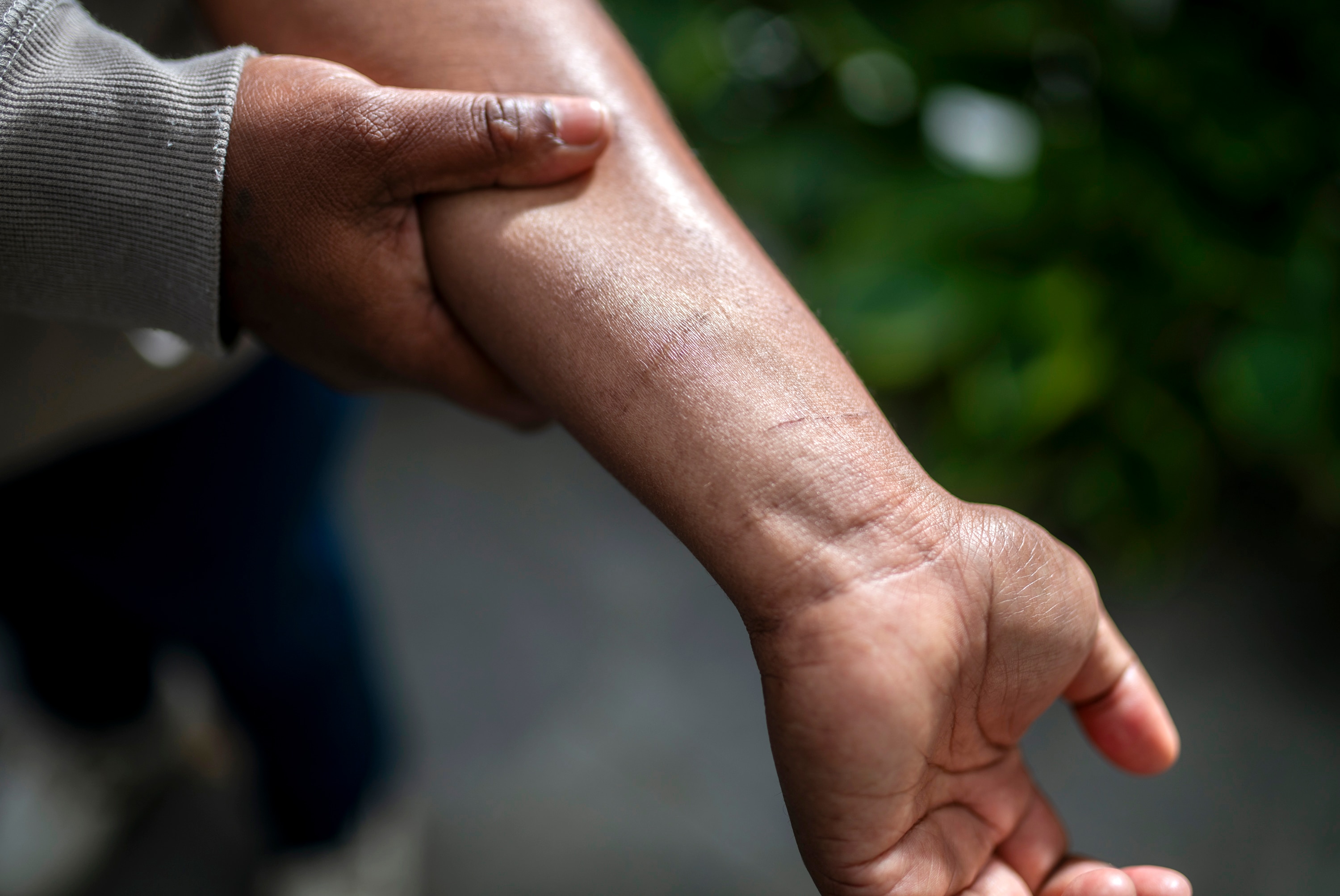 A women raises her sleeve to show scars on her forearm.