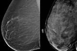 Two ultrasound images - one of a fatty breast and the other of a dense, fibrous breast