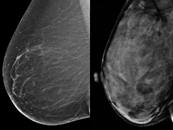 Two ultrasound images - one of a fatty breast and the other of a dense, fibrous breast