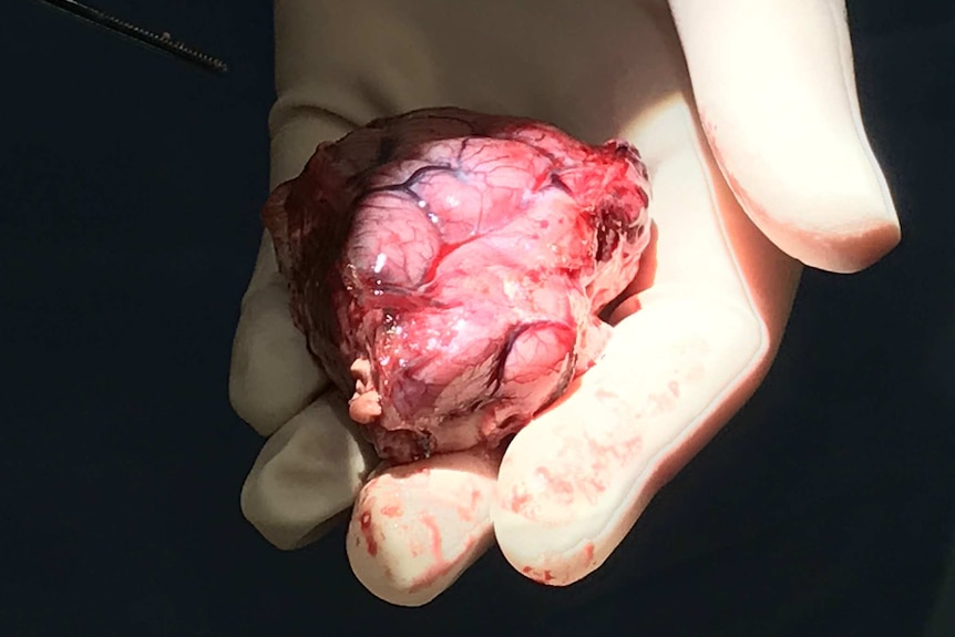 A surgeon holds a golf-ball size lump of tumor