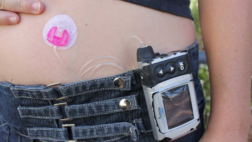 A small insulin pump inserted into a woman's stomach
