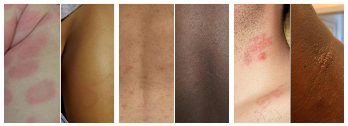 A collage of three photos. Each photo shows a skin condition on white and black or brown skin. Only the white skin has redness.