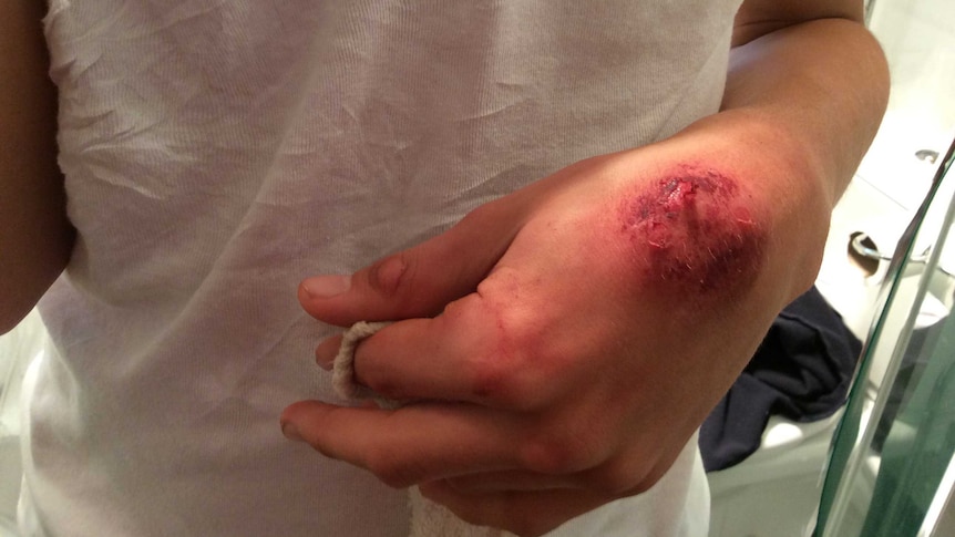A red bite mark on Austin Frank's hand.