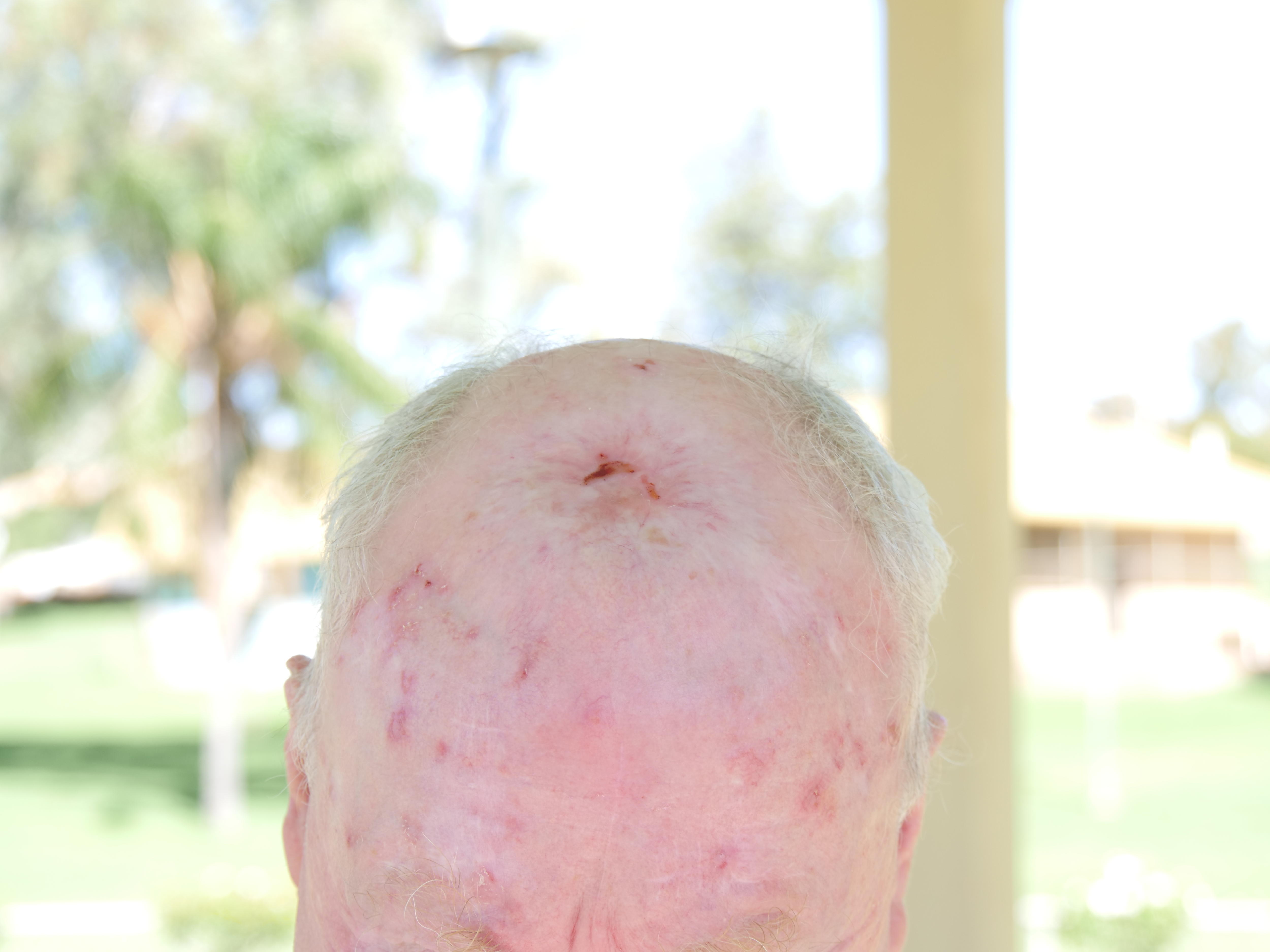 Skin cancer clinic opens in Broken Hill as increase in cases expected ...