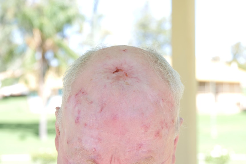 A close up of a Caucasian man's head with a large scar, grey hair on  the sides.