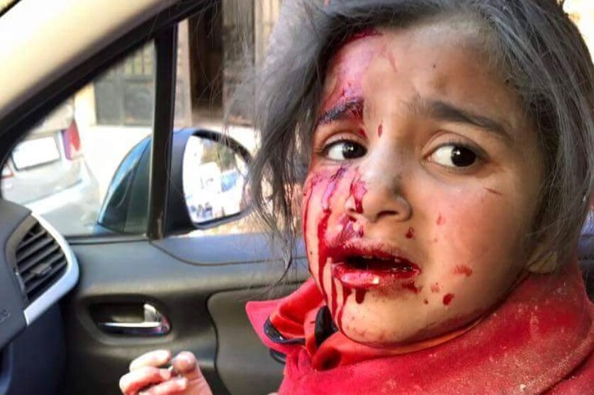 An injured Syrian girl in Aleppo