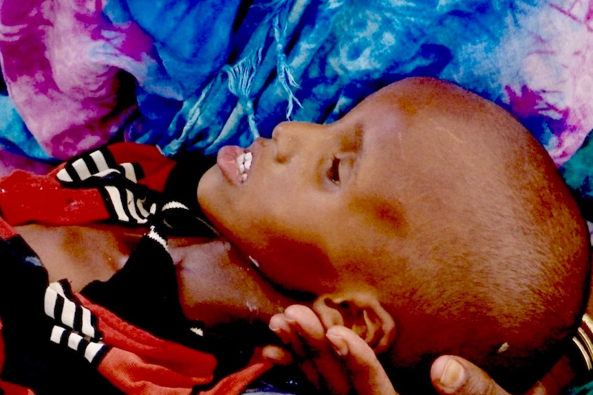 A severely malnourished Somaliland child lies in a person's arms.
