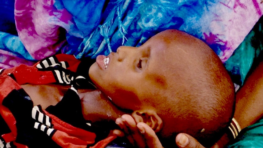 A severely malnourished Somaliland child lies in a person's arms.