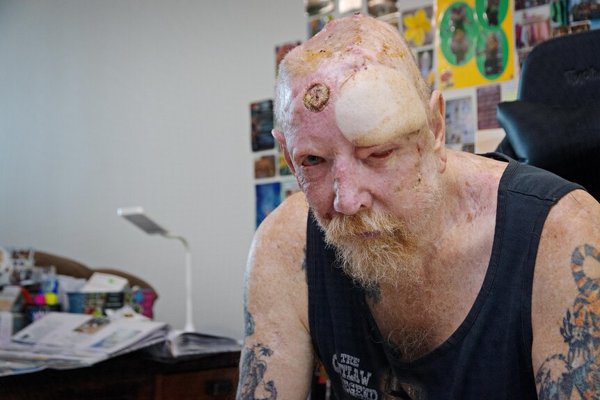 A man with skin cancers sits in a chair in Darwin. 