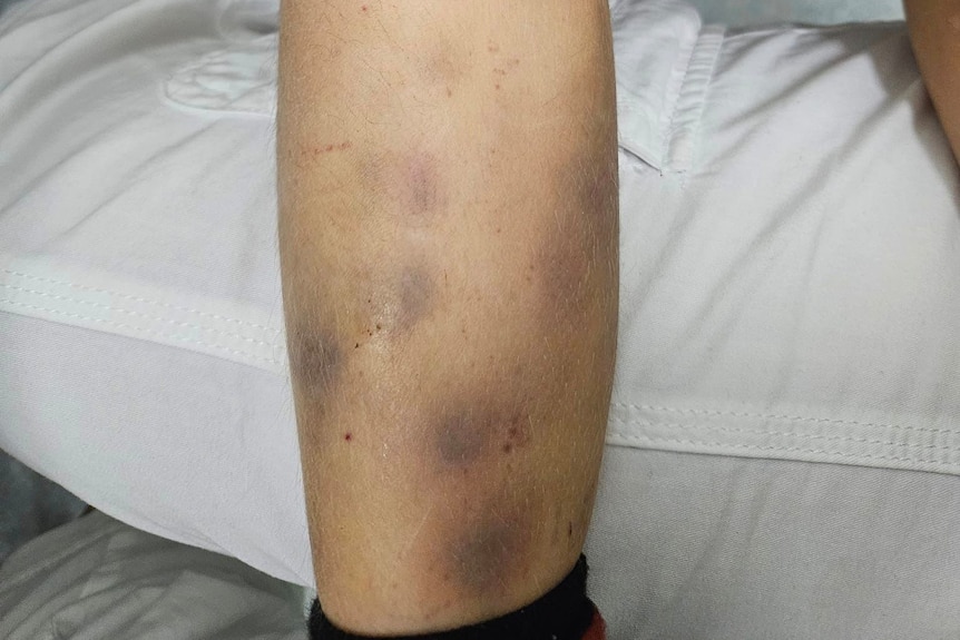 The lower leg of a young boy, covered in dark coloured bruises.