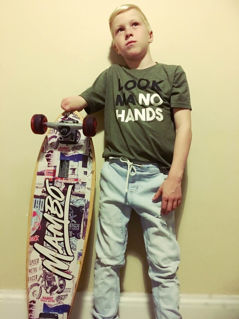 A boy with an amputated forearm standing next to a skateboard