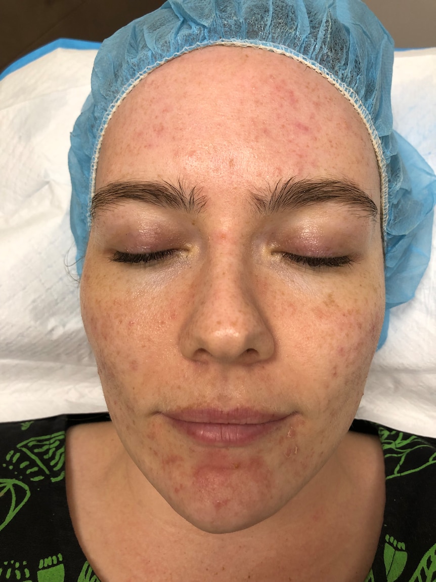 A close up image of a woman's face with acne scars