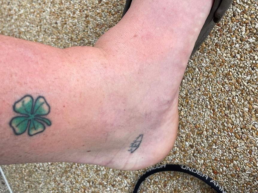 A severely swollen ankle with a four-leafed clover tattoo. 