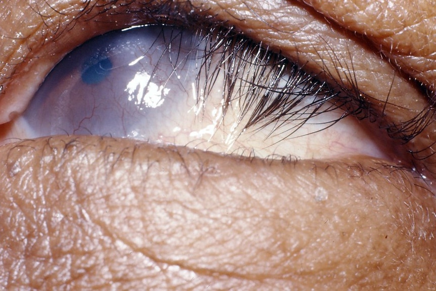Close-up of corneal scarring due to trichiasis in trachoma.