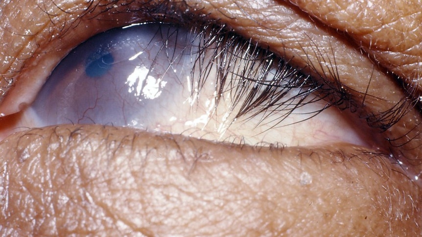 Close-up of corneal scarring due to trichiasis in trachoma.