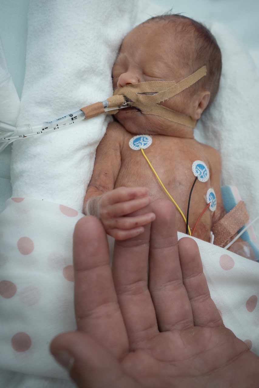 Un bebé prematuro en una cama del hospital. 