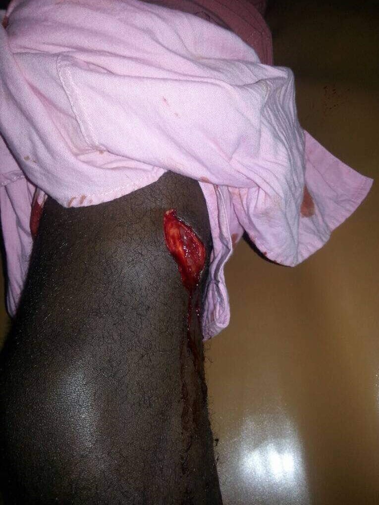 A deep cut in the leg of a 27-year-old man. There is blood in the wound, which he said was caused by a machete attack.