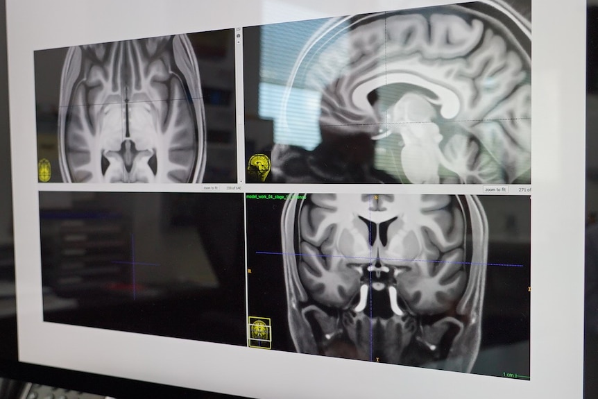  Brain scans of a patient with Parkinson's disease on a computer screen.