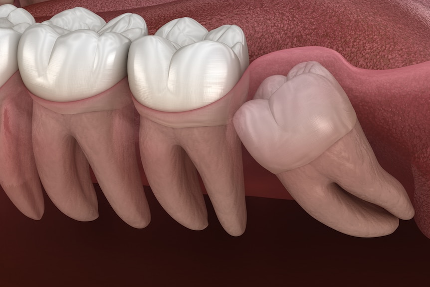 Illustration of teeth showing an impacted wisdom tooth growing sideways