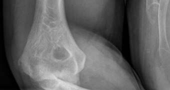 Arm x-ray