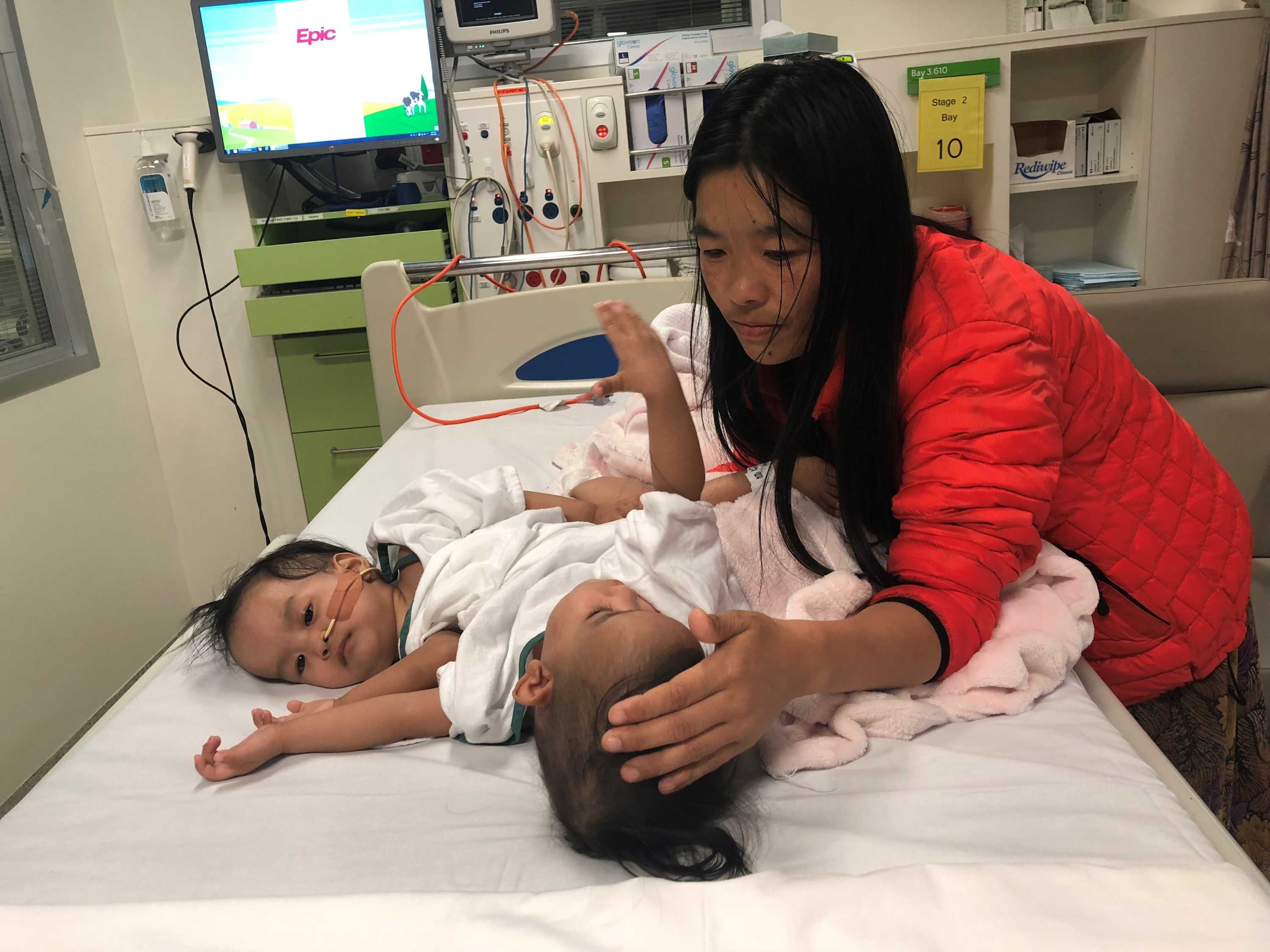 Conjoined Twins Successfully Separated During Six Hour Operation In Melbourne Abc News