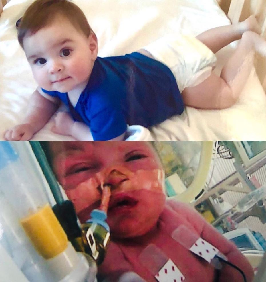 Two pictures of the same baby. One in a hospital crib with tubes attached one six months later of a healthy looking baby.  