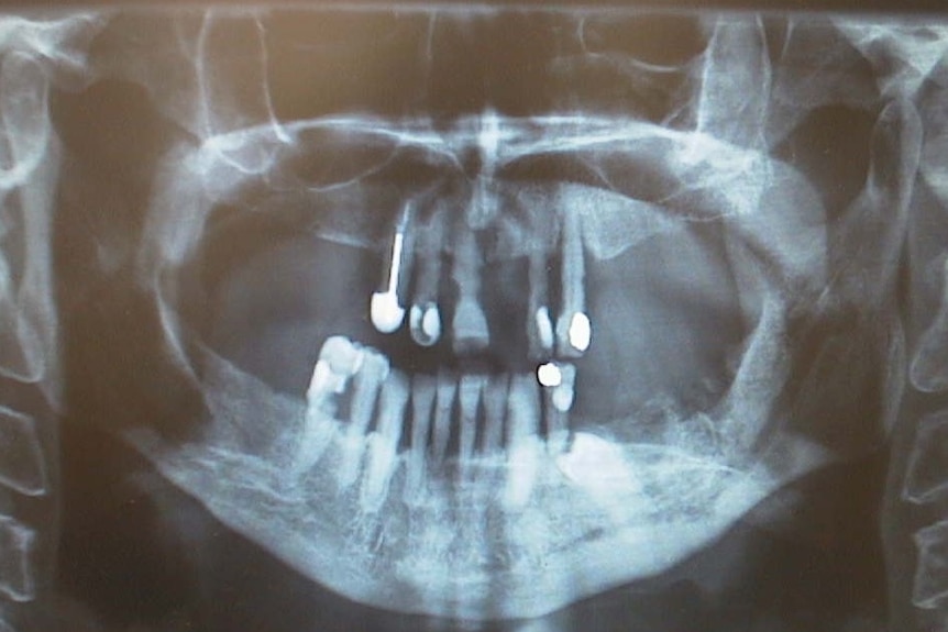 A dental X-ray shows many teeth missing in a mouth.