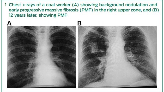 Chest x-ray of coal worker