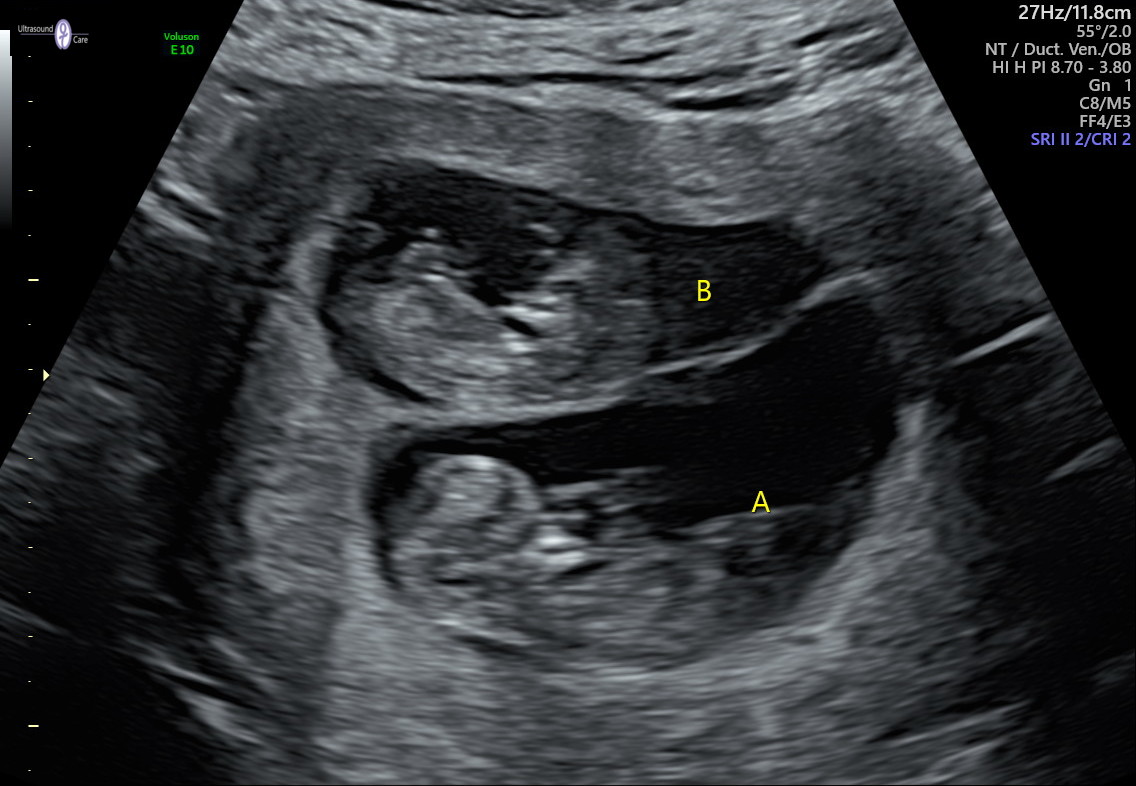 An ultrasound image shows twins in-utero