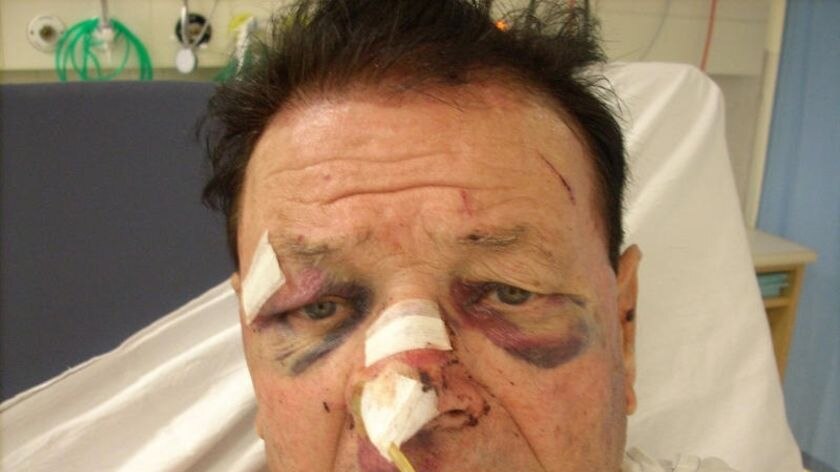 Mario Pesce shows the injuries he sustained when he and his wife were bashed