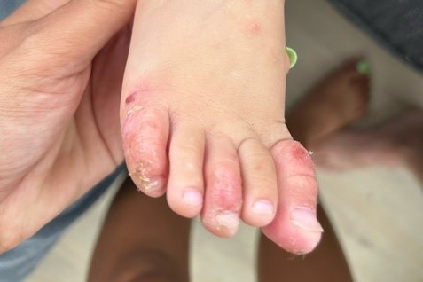 Willow's toes covered in red eczema rashes