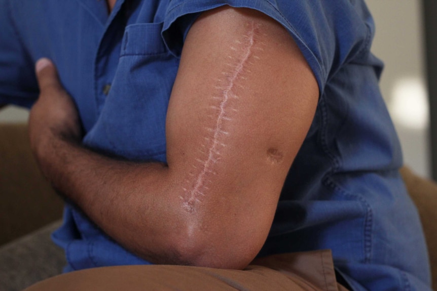 An arm with a long scar.