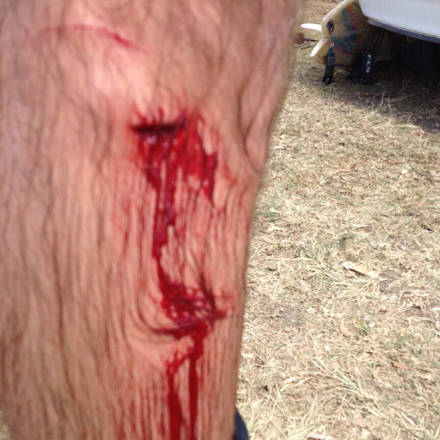 The injuries a surfer suffered in a shark attack on the north coast.
