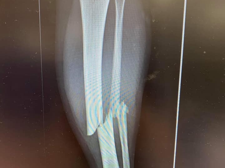 Broken leg x-ray 