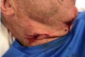 A deep gash on the neck of a man attacked by a dog in Melbourne.