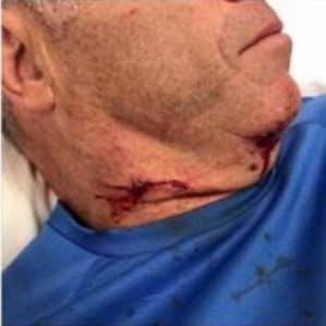 A deep gash on the neck of a man attacked by a dog in Melbourne.