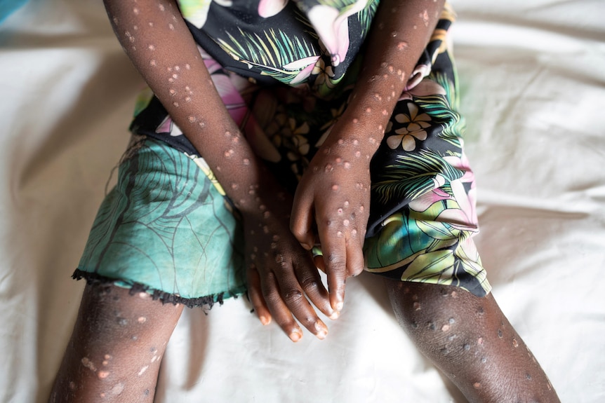 a young girl sits on a bed with her arms and legs covered in lumps which are suspected monkeypox