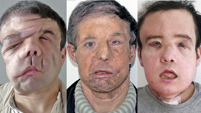 A composite image shows three faces side by side. The first is distorted with tumours, then an older face and a younger face
