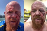 Two-side-by-side images of a bearded man with facial injuries. In one he stands lakeside, the other is in hospital.