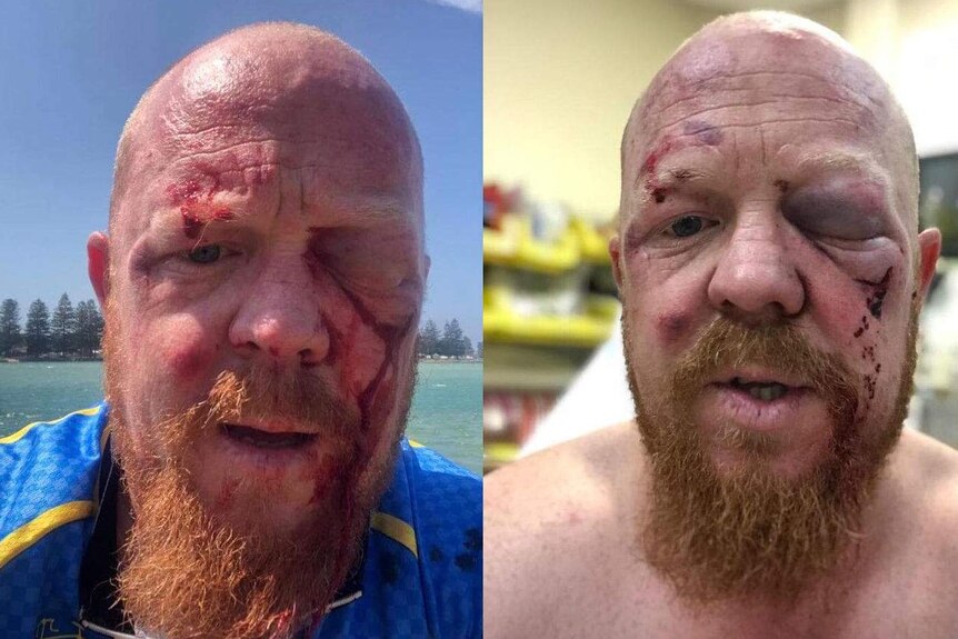Two-side-by-side images of a bearded man with facial injuries. In one he stands lakeside, the other is in hospital.