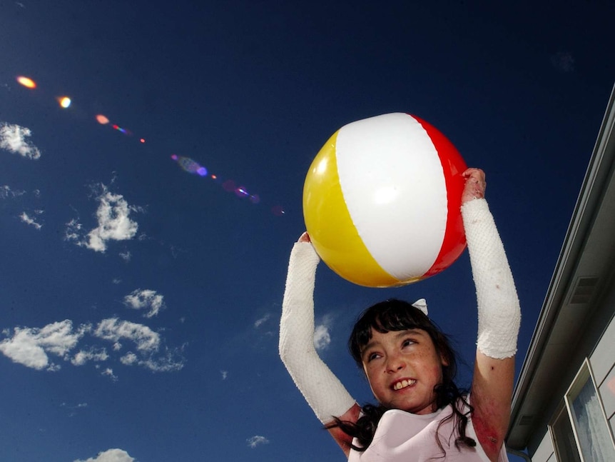 A 9-year-old girl with epidermolysis bullosa holding a beach ball.